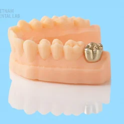 - Vietnam Dental Lab Metal crowns