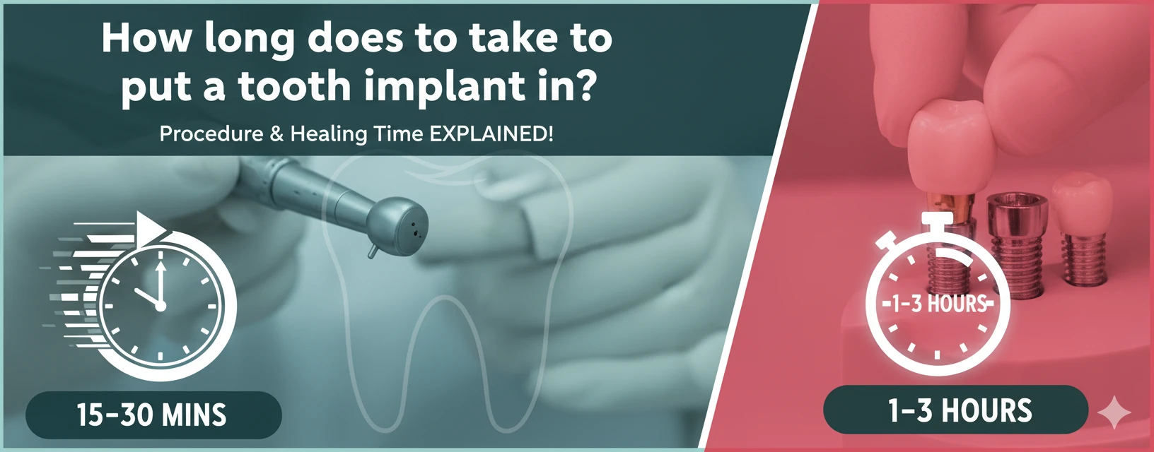 How long does it take to put a tooth implant in? The complete timeline ...